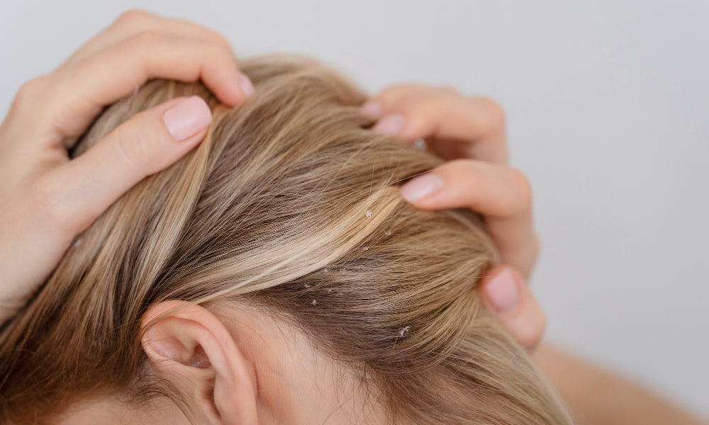 Schuppen loswerden mit Rotlichttherapie: Natürliche Lösung für eine gesunde Kopfhaut